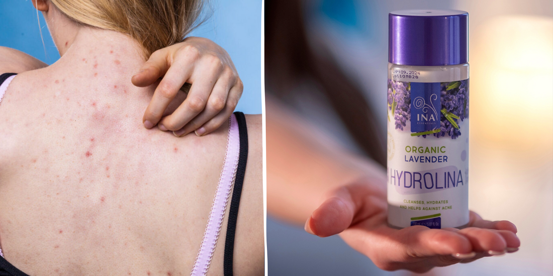 Kaip Daugiau nei 100 000 europiečių Pašalino Spuogus nuo Nugaros be Vaistų 3 Paprastais Žingsniais  su Levandų vandeniu