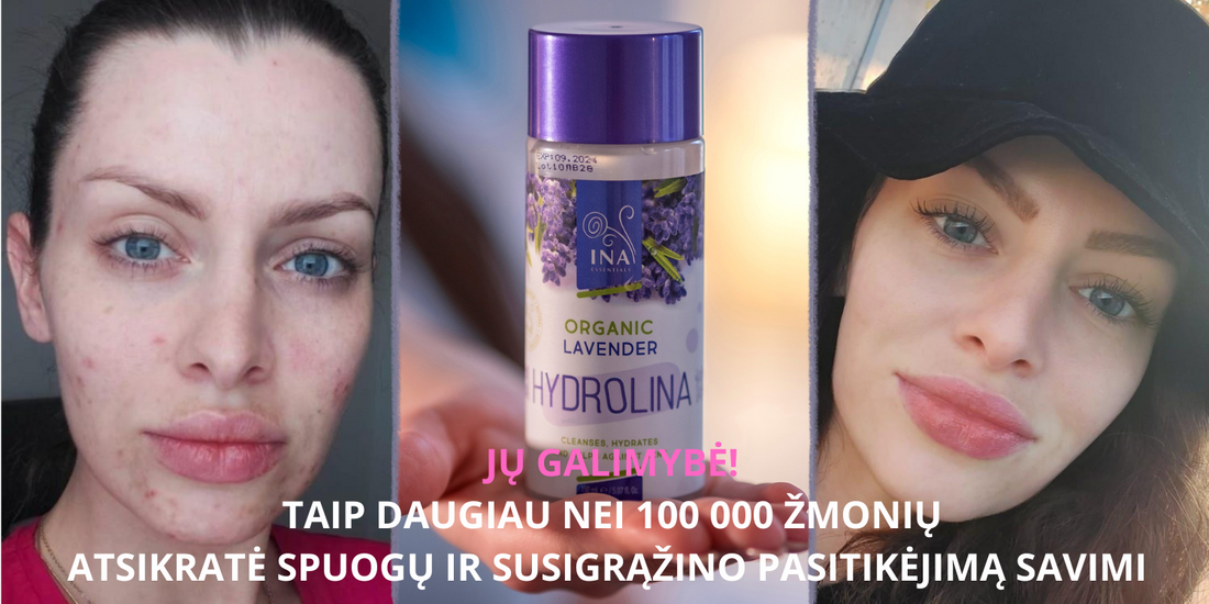 7 PAPRASTI ŽINGSNIAI, Kaip Atsikratyti Spuogų BE VAISTŲ!