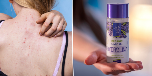 Turite Nemalonių Spuogų ant Nugaros ir Krūtinės? Daugiau nei 300 000 Žmonių jau Pasakė „Iki Pasimatymo!“ Aknei su Hydrolina!