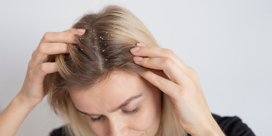 Metus kovojau su pleiskanomis... kol vienas mažas buteliukas pakeitė viską