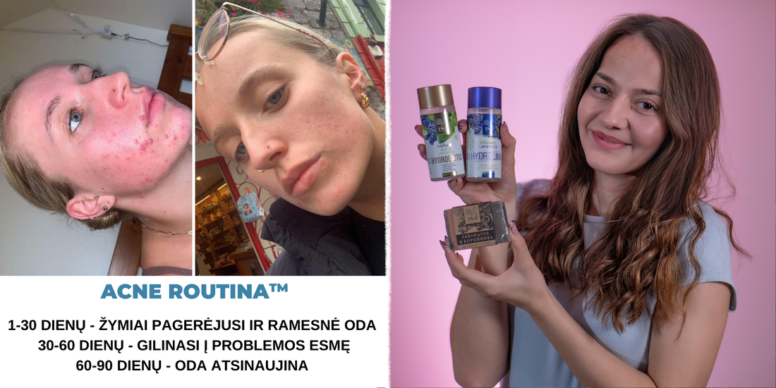 Jei Тaip Darysite, Spuogai NEišnyks! 5 Kasdienės Klaidos, Bloginančios Spuogų Būklę (Ir Kaip Jų Išvengti!)