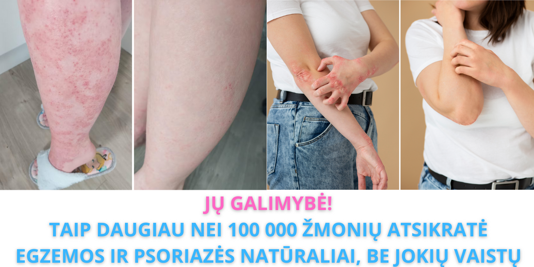 Atsisveikinkite su Egzema 3 Paprastais Žingsniais - su Natūraliu Vandeniu, Apie Kurį Kalba Visi