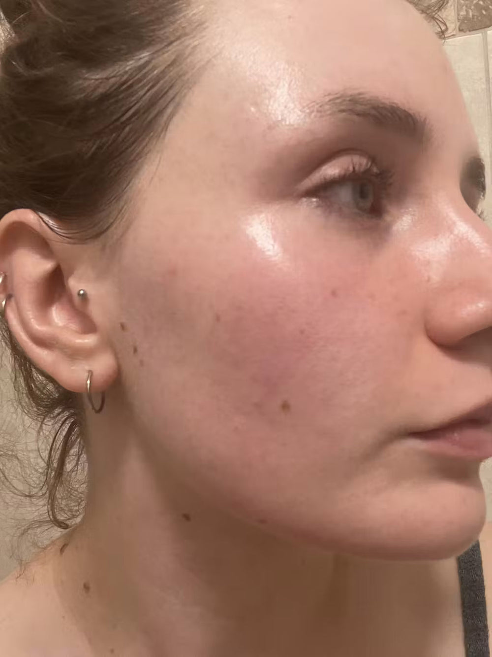 acne LT keep