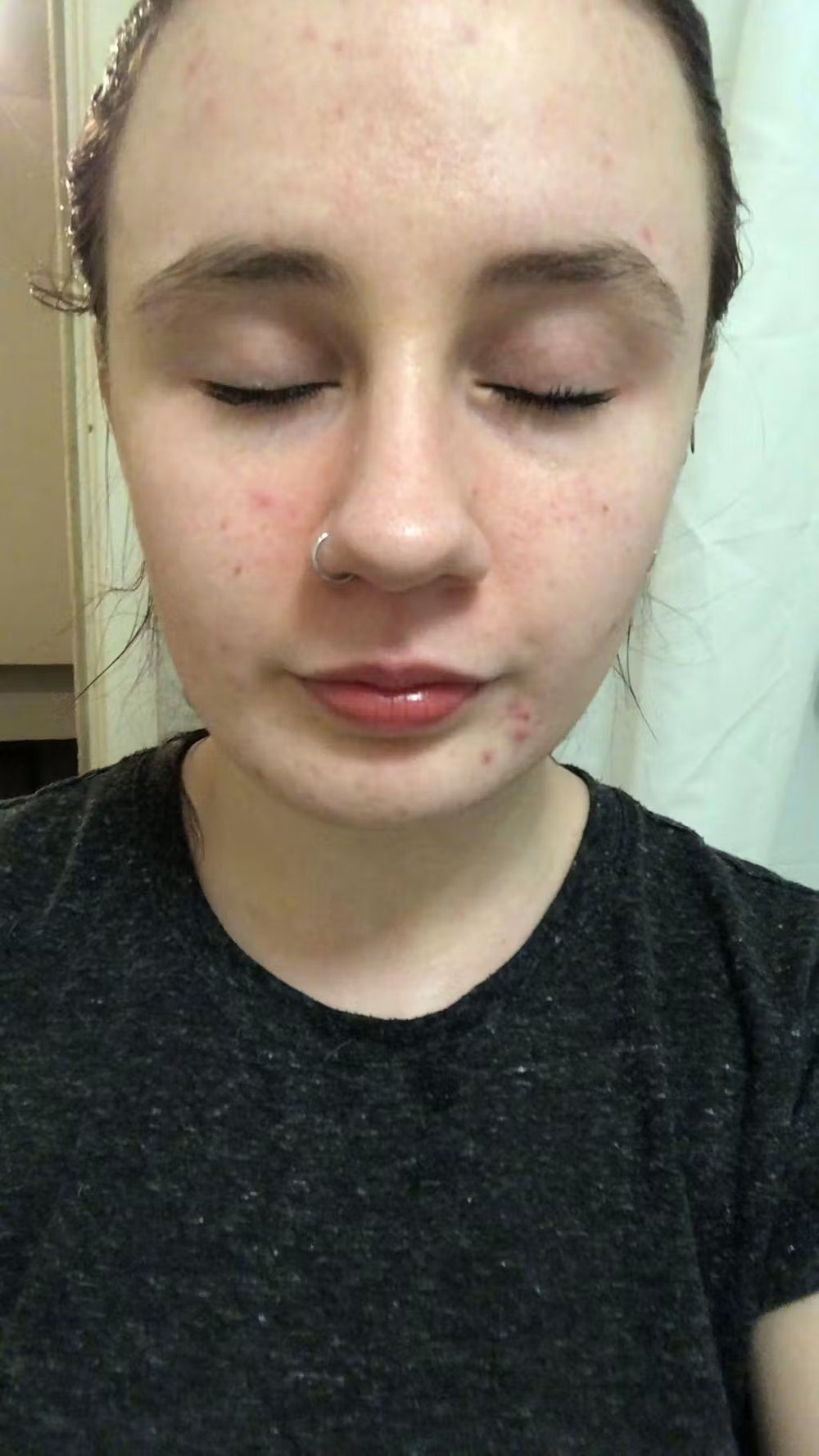 acne LT keep