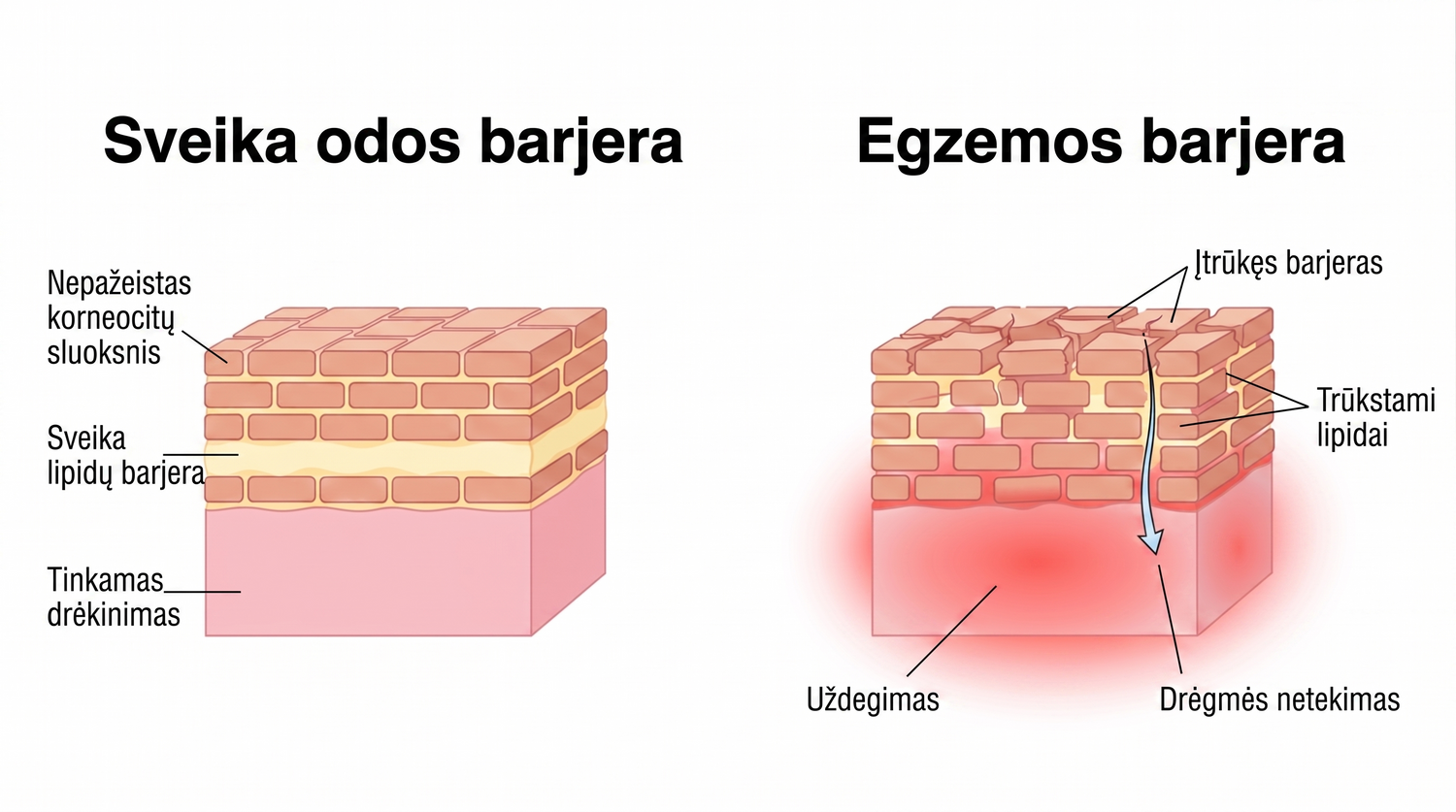 eczema_LT_skin_barrier_v2.png